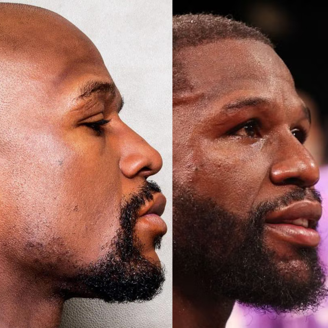 Floyd Mayweather A Boxing Icon and His Battle with Hair Loss