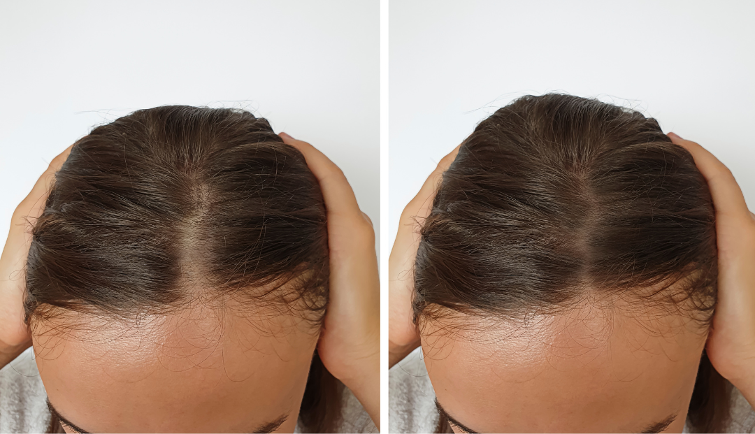 Exosome-Hair-Therapy