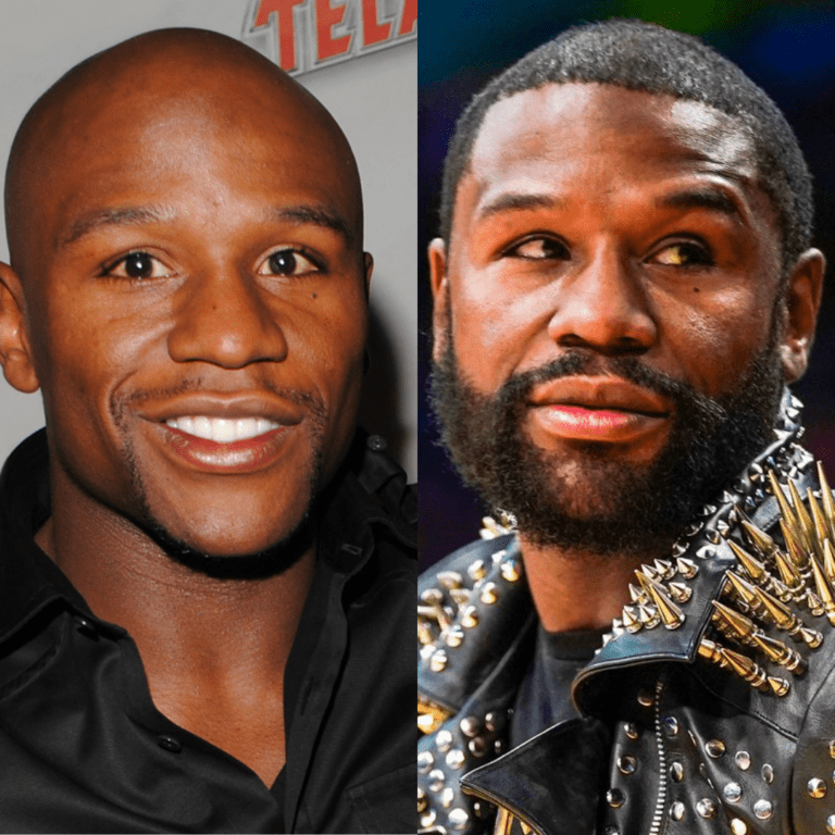 Floyd-Mayweather-Hair-Transplant