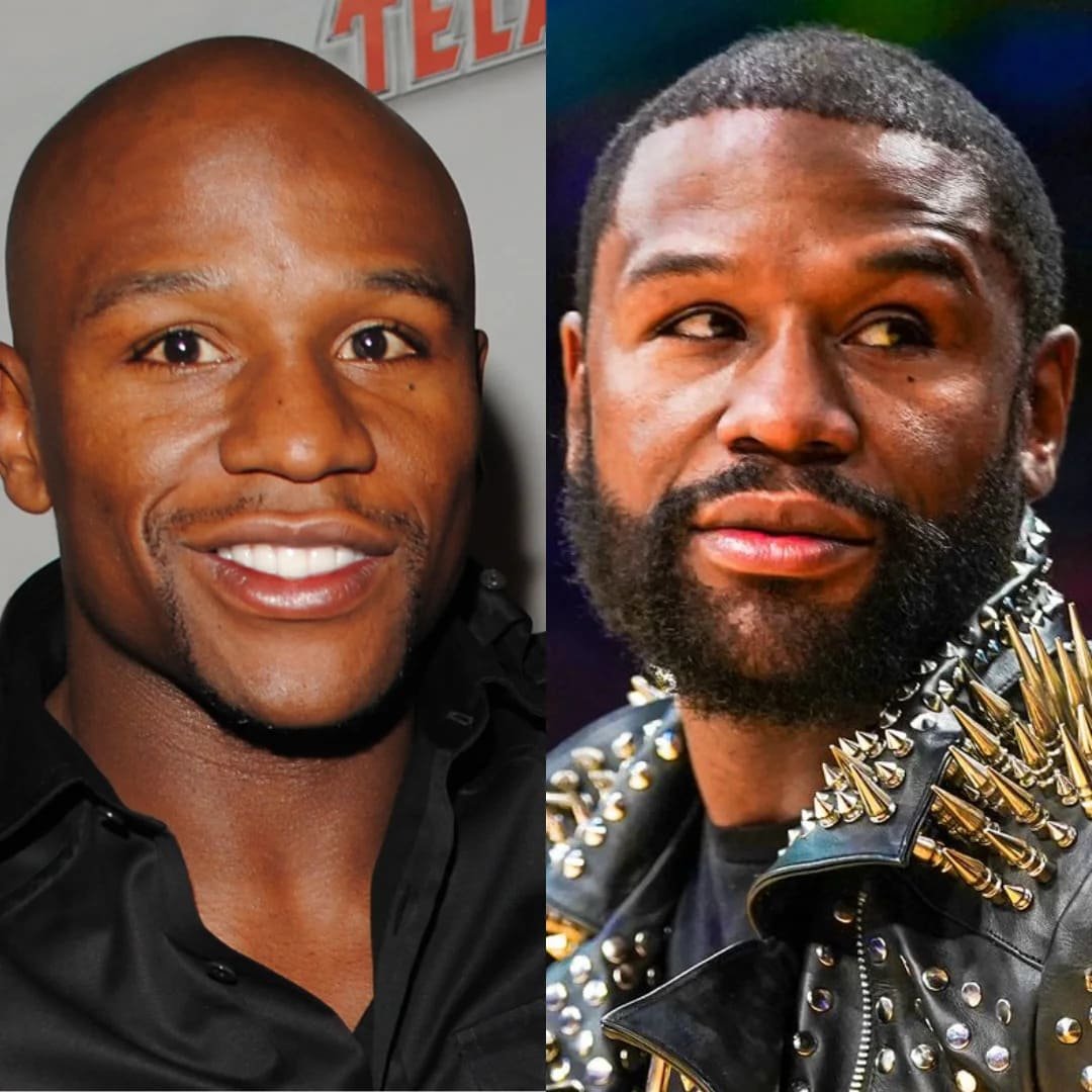 Floyd Mayweather - Hair Transplant Before & After
