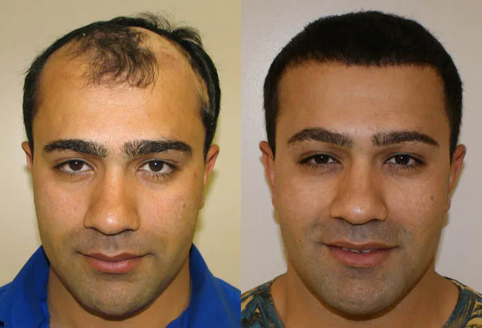 Great-Hair-Transplants-Miami-result-1