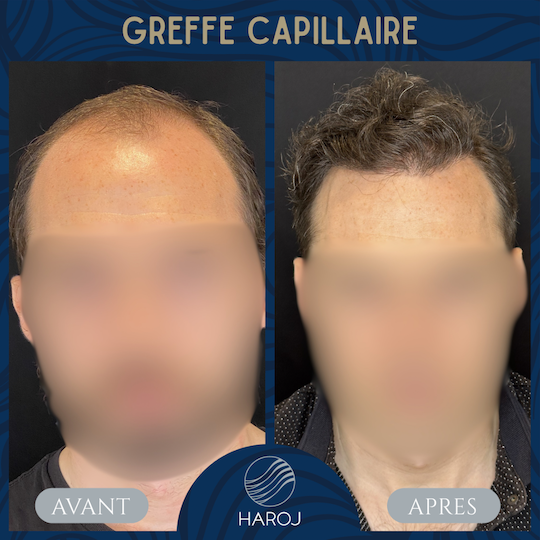 Before and after FUE hair transplant results showing natural hairline restoration at Haroj Clinic in Mulhouse, France.