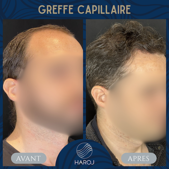 Side view before and after FUE hair transplant showing improved density and natural hairline at Haroj Clinic France.