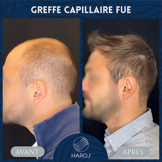 Top view before and after FUE hair transplant showing increased density in the frontal and mid-scalp area at Haroj Clinic.