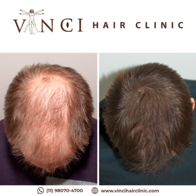 Vinci Hair Clinic, London