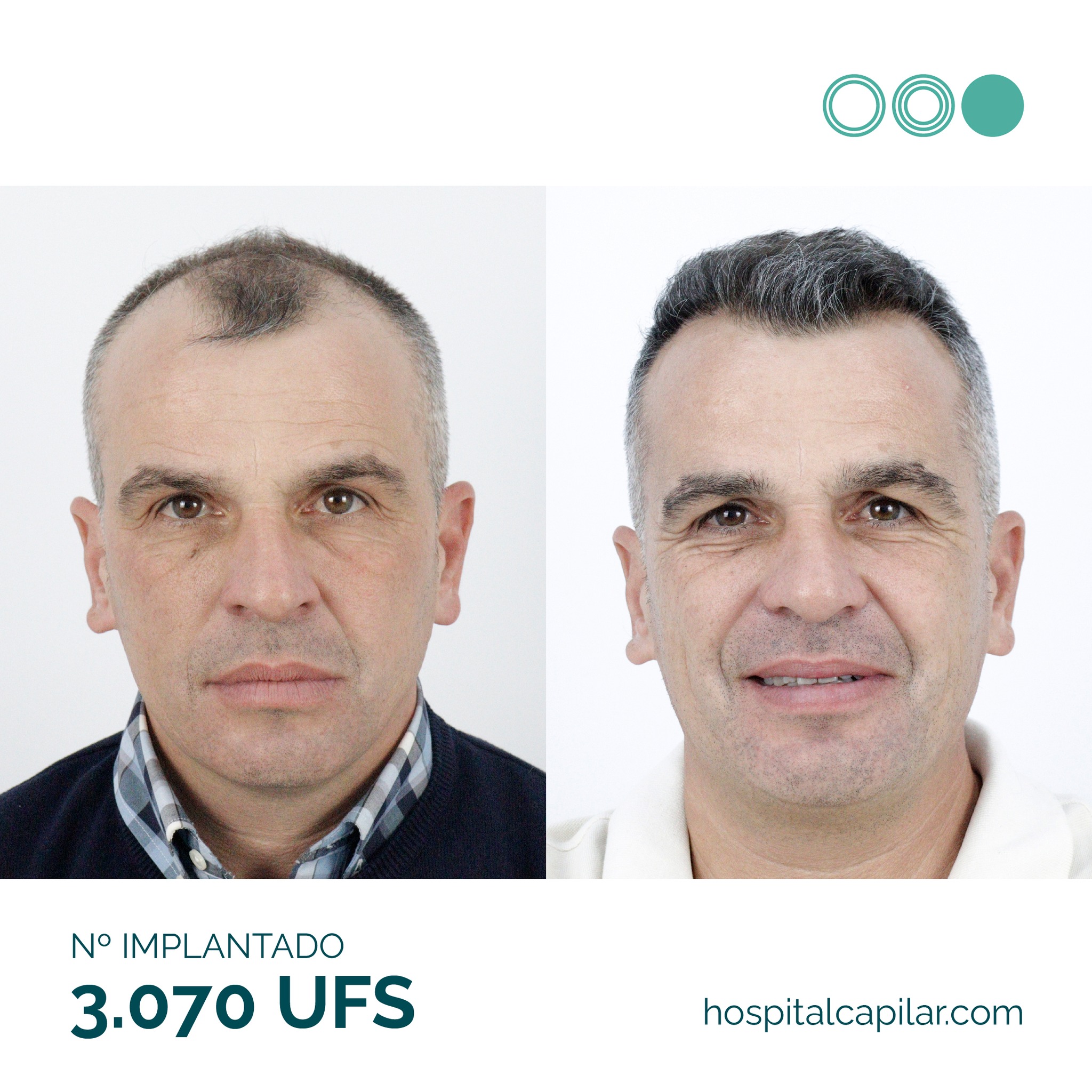 Hospital-Capilar-Madrid-result 1