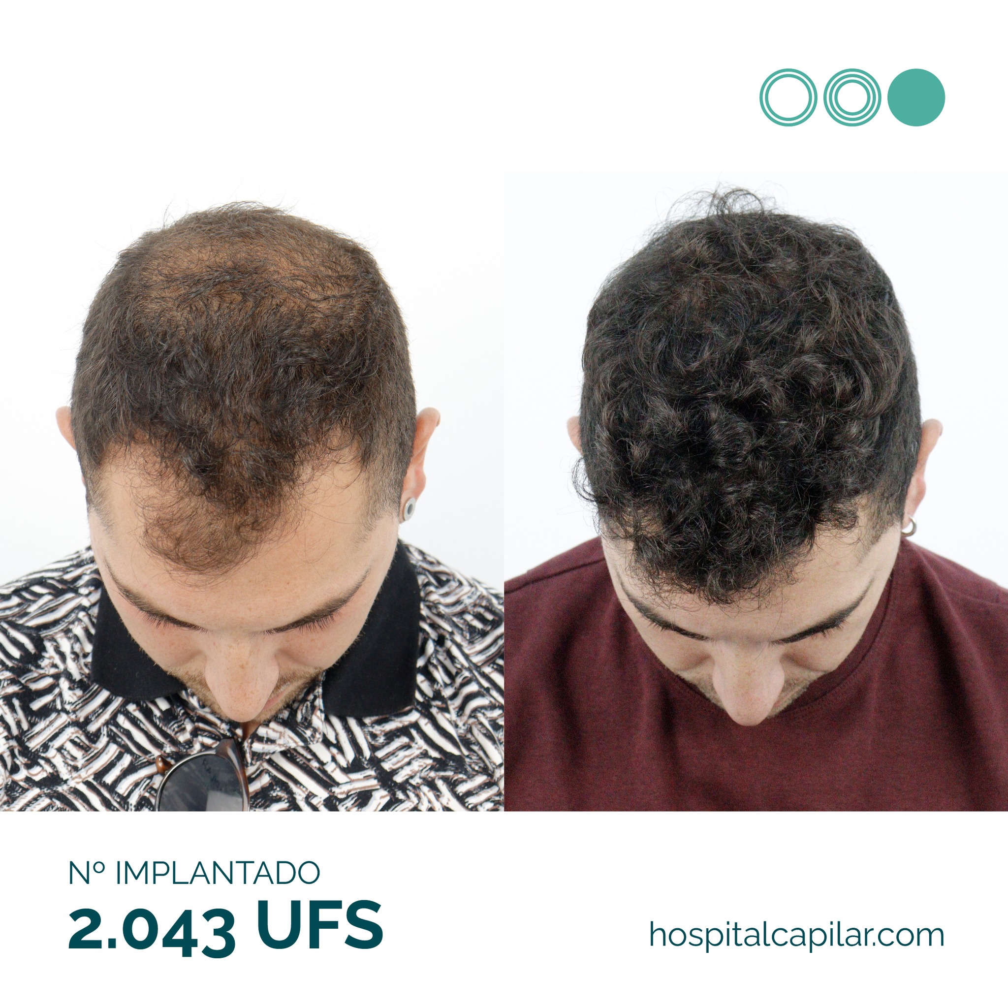 Hospital-Capilar-Madrid-result 2