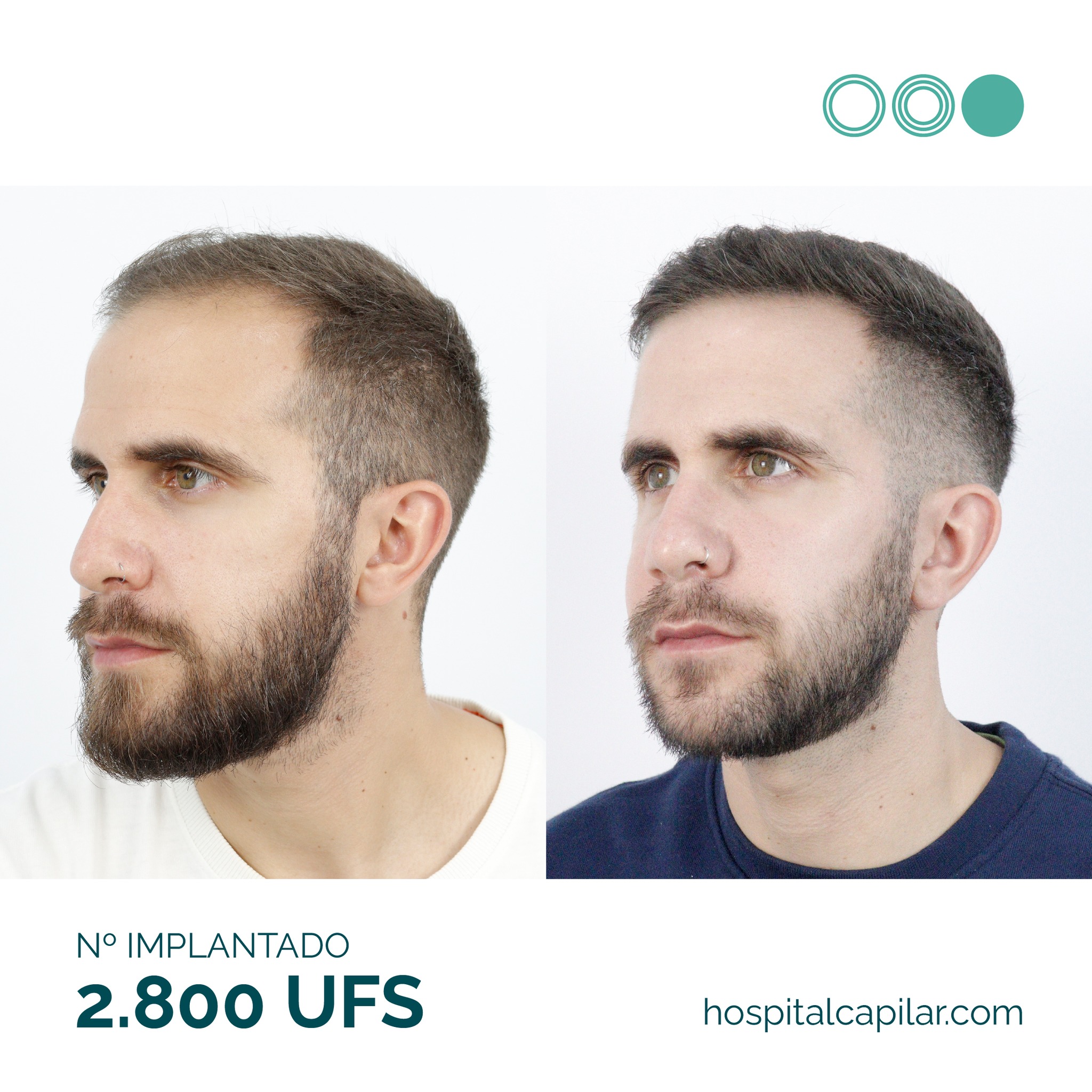 Hospital-Capilar-Madrid-result 3