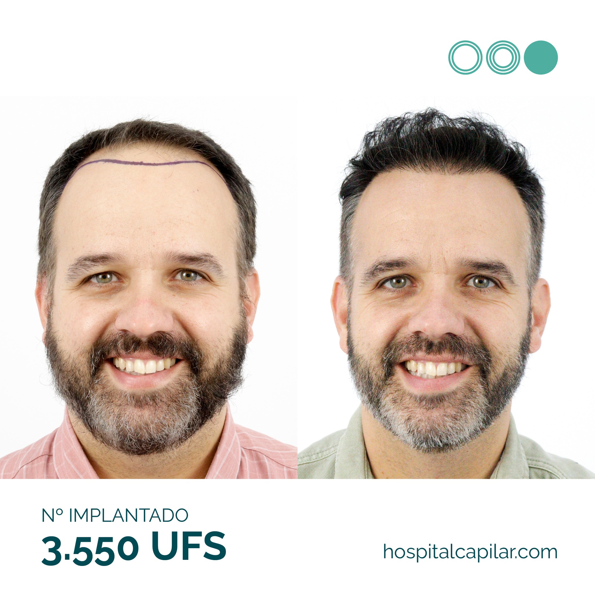 Hospital-Capilar-Madrid-result 4