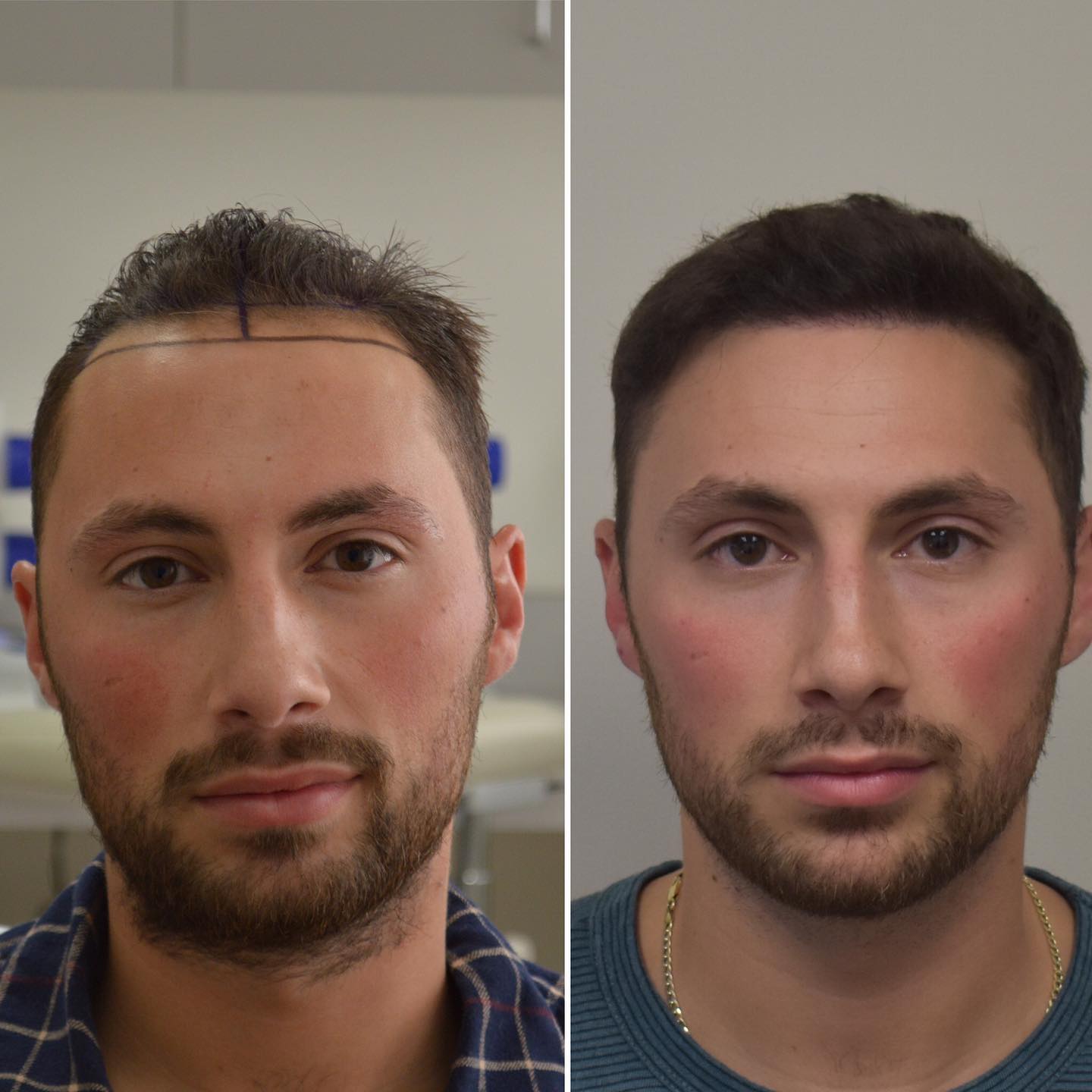 LA-FUE-Hair-Clinic-before-after-1