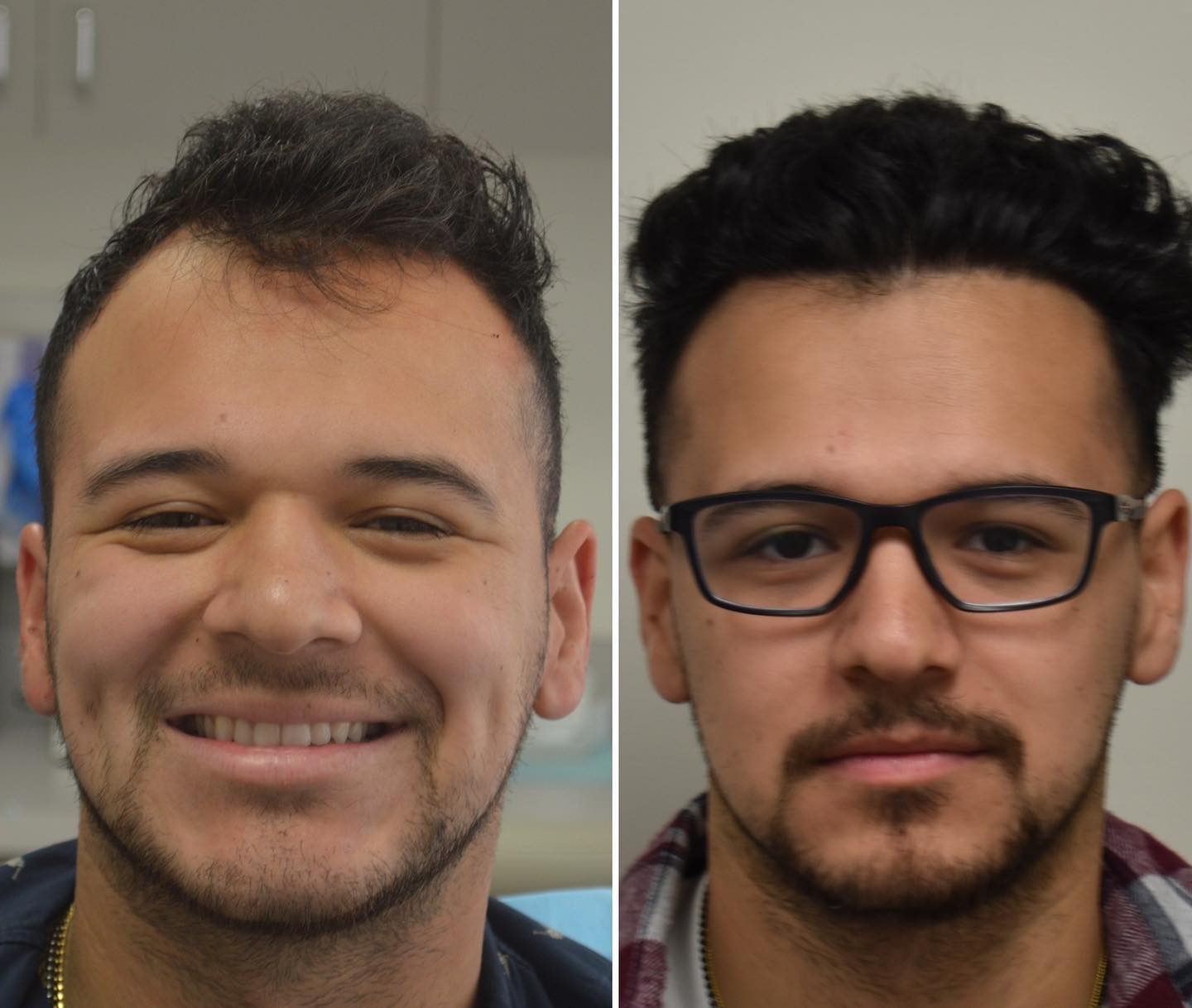 LA-FUE-Hair-Clinic-before-after-3