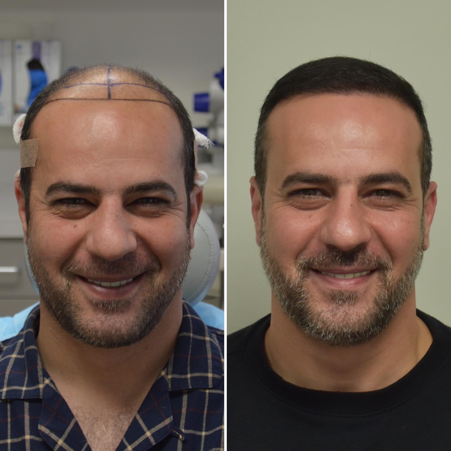 LA-FUE-Hair-Clinic-before-after-4