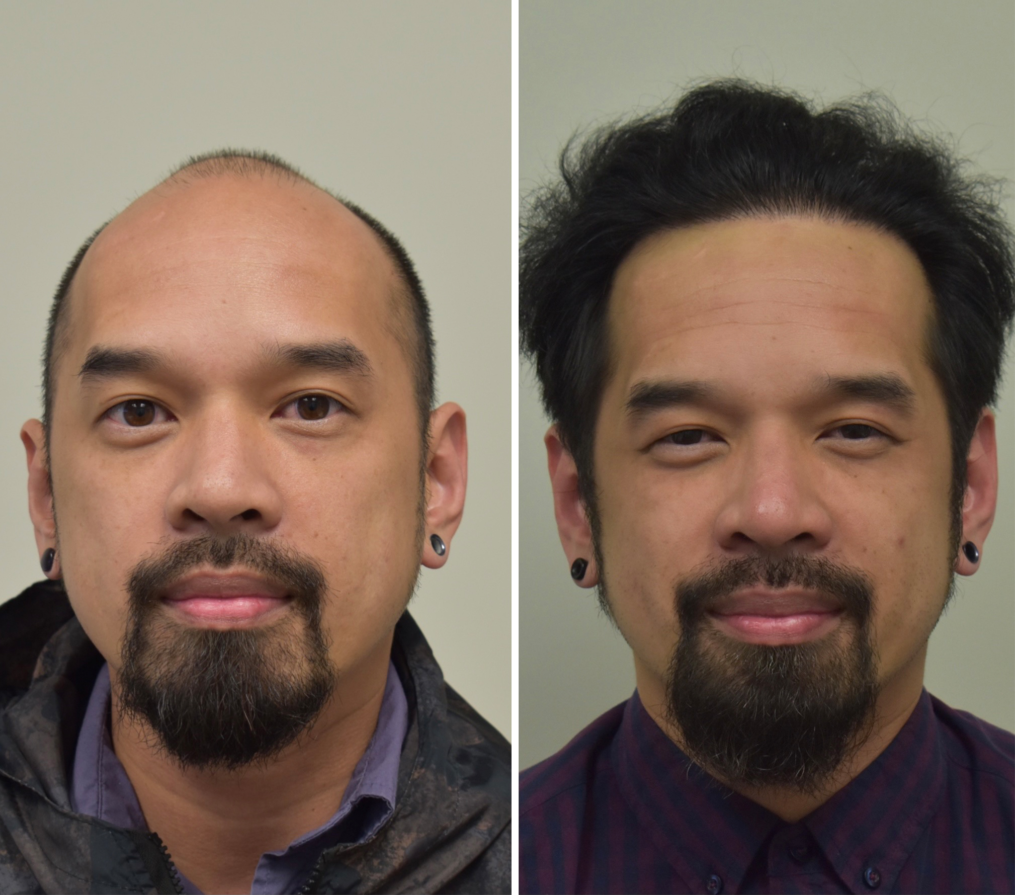 LA-FUE-Hair-Clinic-before-after-5