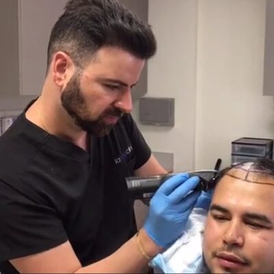 Los Angeles FUE Hair Transplant Clinic, California