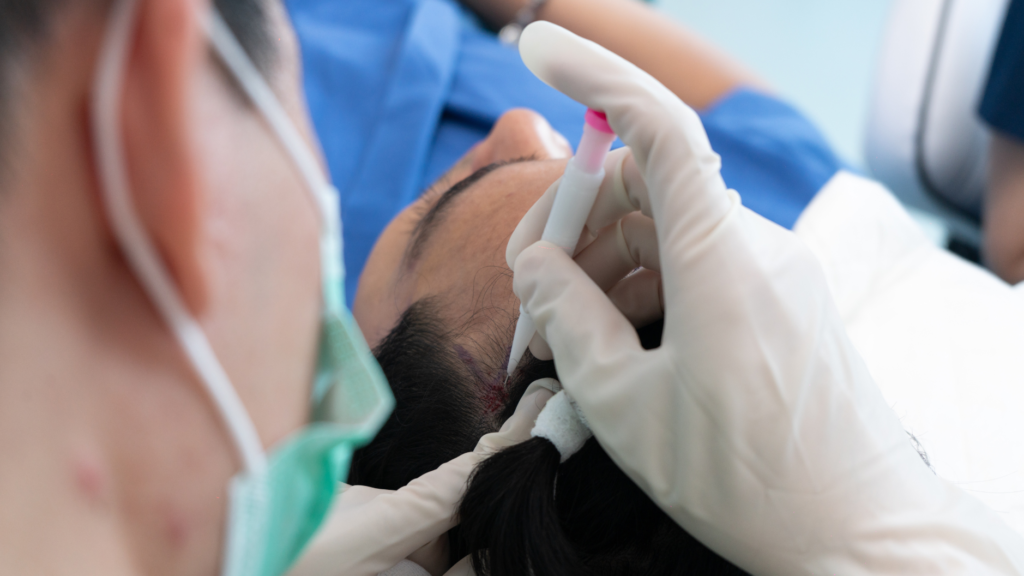 Hair transplant patient with visible shedding during the resting phase
