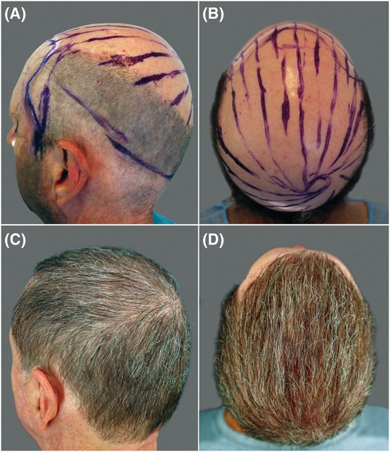 SRFD patient results of nonscalp FUE