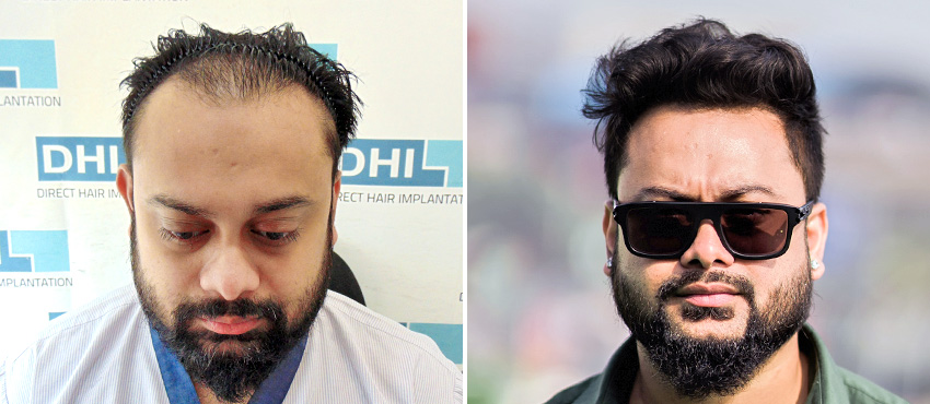 DHI India Before and After Hair Transplant Results