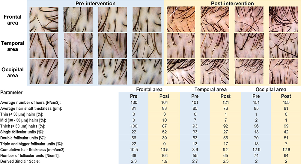 Pre- and post ADSC-CM trichometry