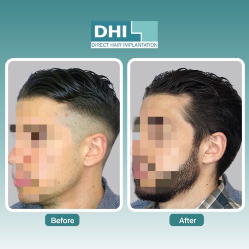before-after-dhi-thailand