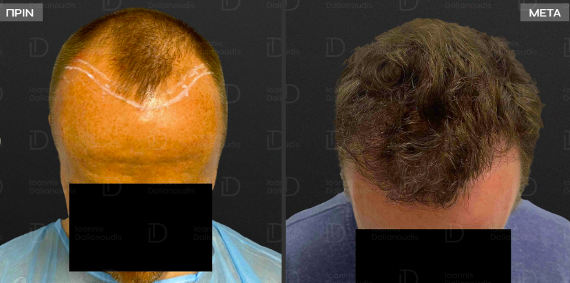 Σύγκριση πριν και μετά που δείχνει φυσική αποκατάσταση της γραμμής των μαλλιών χρησιμοποιώντας την τεχνική μεταμόσχευσης μαλλιών DHI που πραγματοποιήθηκε στην Αθήνα, Ελλάδα.
