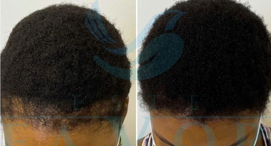Αποτελέσματα Μεταμόσχευσης Αφρικανικών Μαλλιών Πριν και Μετά