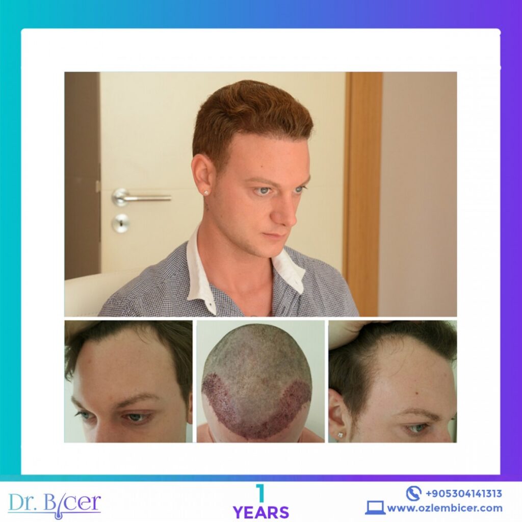 Dr. Bicer Istanbul Hair Restoration – Before and After