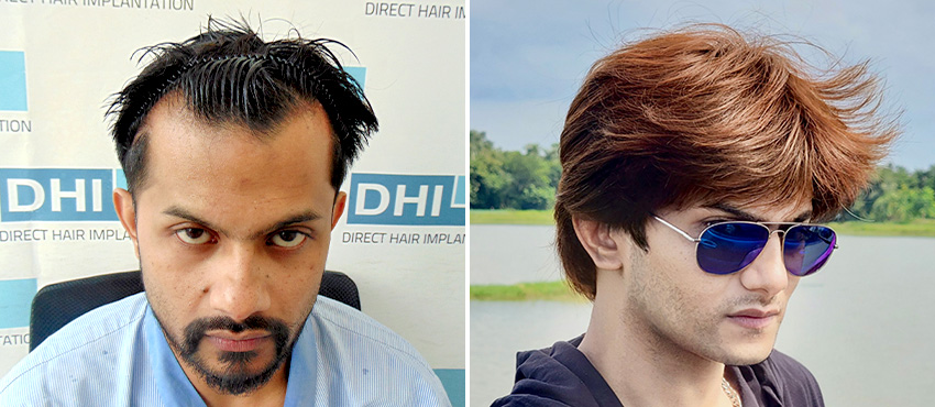 DHI India Before and After Hair Transplant Results 2