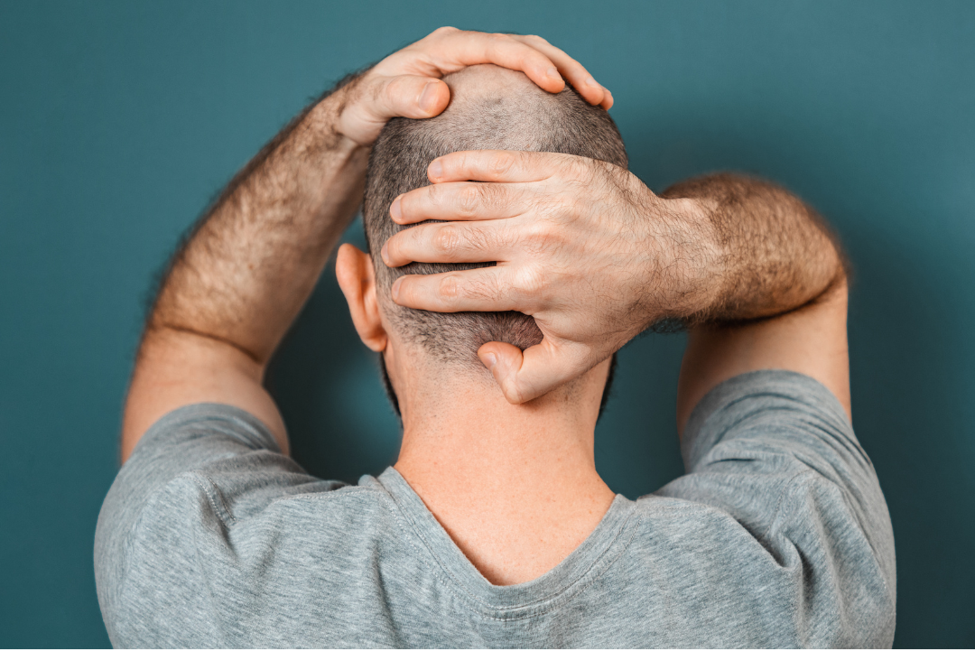 Alopecia Areata: Causes, Symptoms, And Treatment Options : Top Hair ...