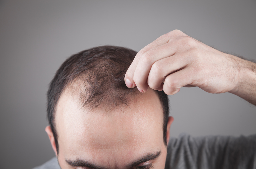 Patient experiencing early shock loss after hair transplant surgery