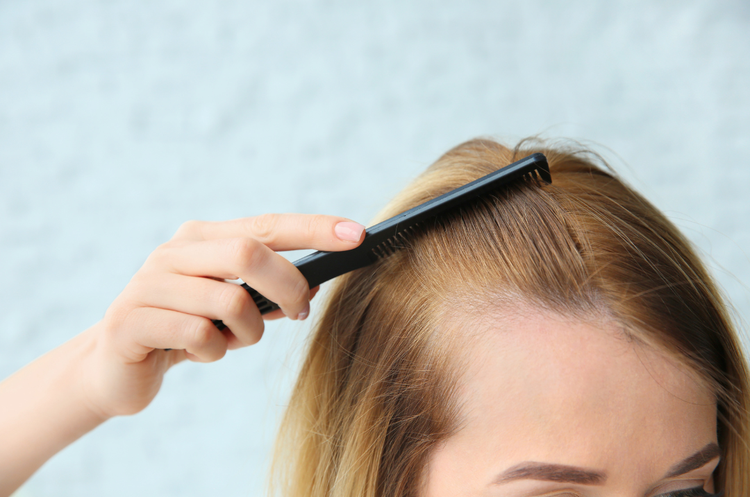 Female-pattern-baldness
