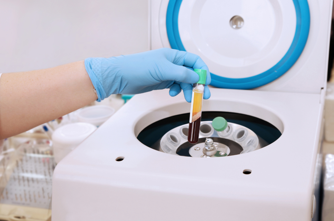 prp-treatment