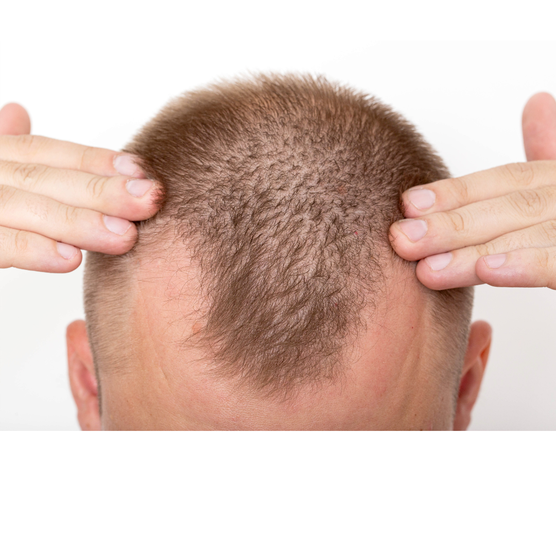the best hair transplant clinic