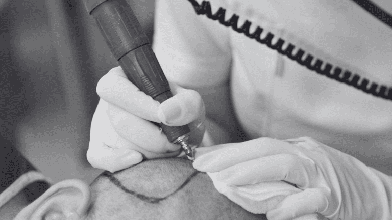 Comparison between AVA FUE and traditional FUE hair transplant techniques