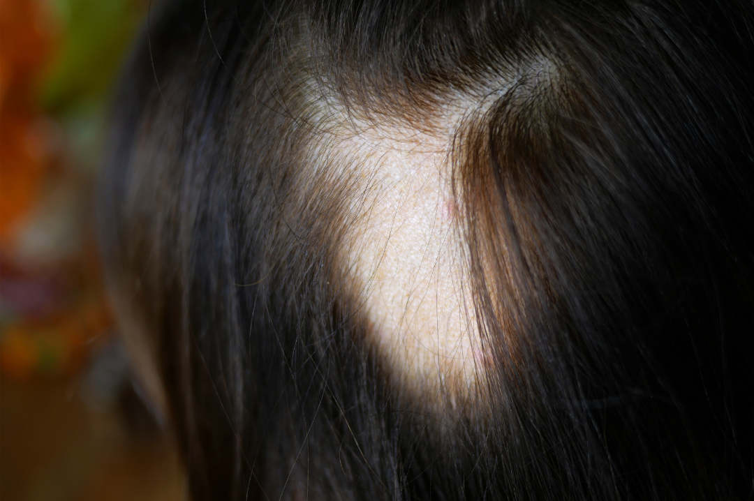 alopecia-areata