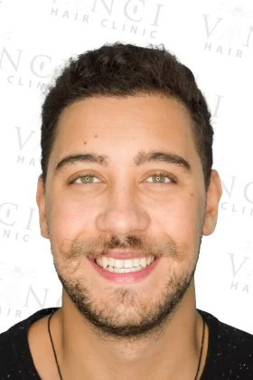Vinci-Hair-Clinic-London-after-1