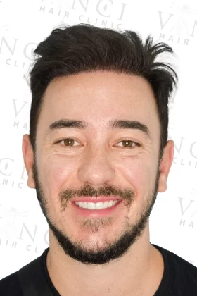 Vinci-Hair-Clinic-London-after-4