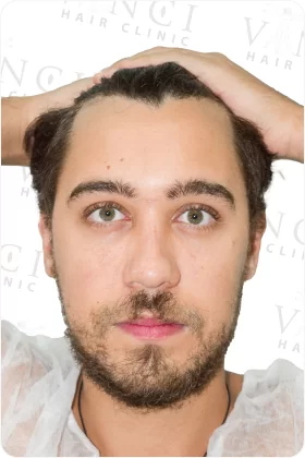 Vinci-Hair-Clinic-London-before-1