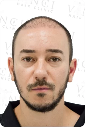 Vinci-Hair-Clinic-London-before-4