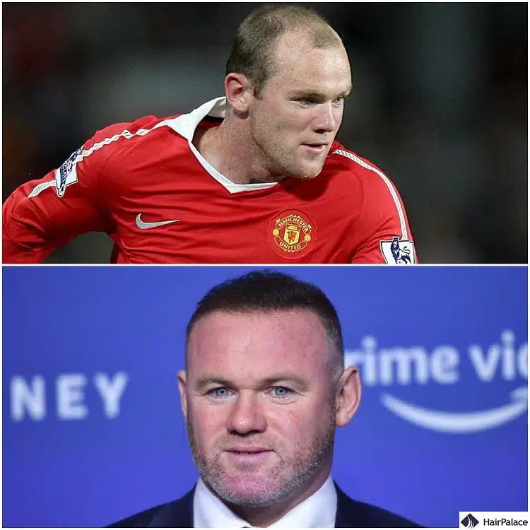 Wayne-Rooney-saç ekimi öncesi ve sonrası