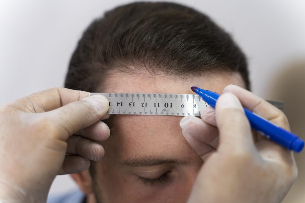 Short Hair FUE vs Long Hair FUE – Choosing the Best Hair Transplant Method