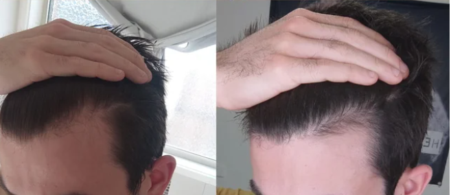 before-after-minoxidil