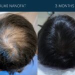 almi-nanofat-before-after