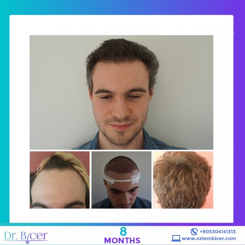 Before and After Hair Transplant Dr. Bicer Istanbul