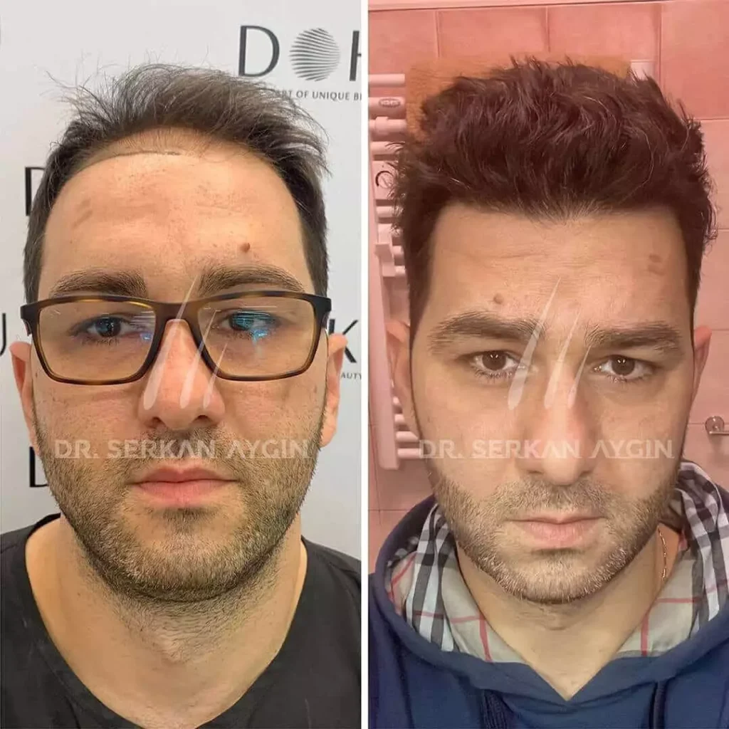 drserkanaygin-before-after