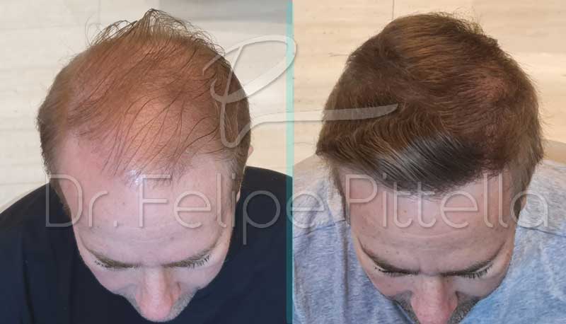 No-Shave FUE hair transplant before-and-after – natural hair restoration without shaving the head.