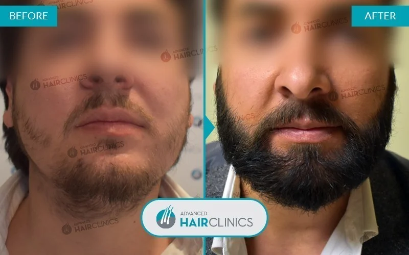 Αποτελέσματα Μεταμόσχευσης Μαλλιών Advanced Hair Clinics – Μεταμόσχευση Γενειάδας