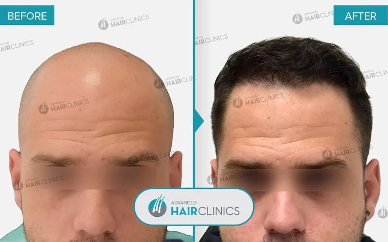 Αποτελέσματα Μεταμόσχευσης Μαλλιών Advanced Hair Clinics – Φυσική Αποκατάσταση Μαλλιών