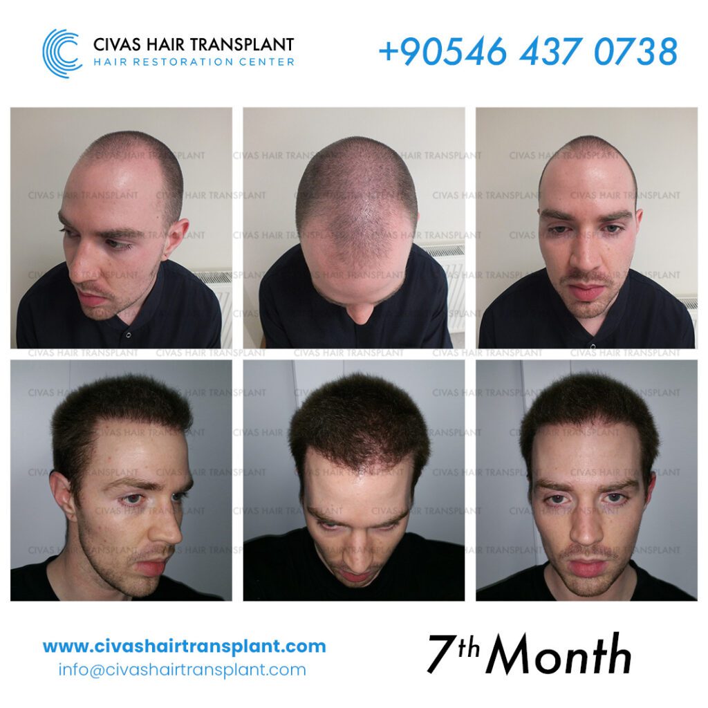 Dr. Ekrem Civas – Hair Transplant Results before-after