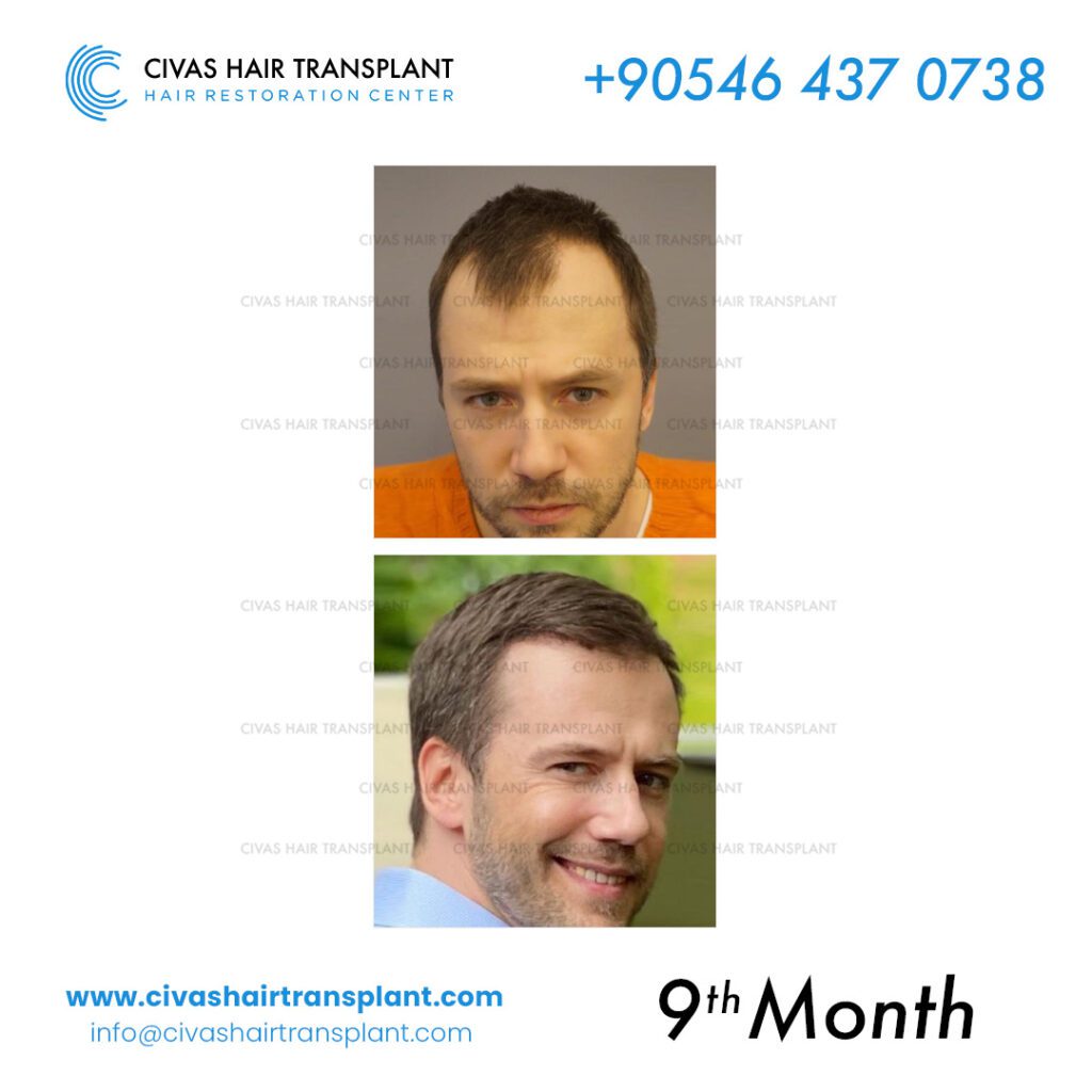 Dr. Ekrem Civas – Advanced Hair Transplant Surgery before-after