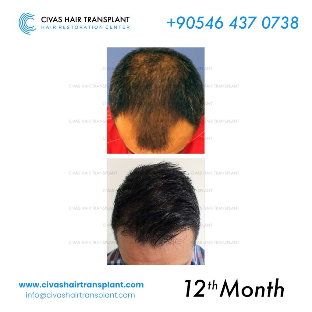 Dr. Ekrem Civas – Natural Hair Transplants-before-after
